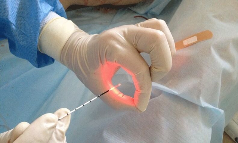 tratamento a laser para prostatite